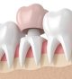 How Does A CEREC Same Day Dental Crown Compare to A Crown Crafted in A Lab?